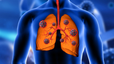Fibrosis quística, la enfermedad genética más frecuente de la raza blanca aún subdiagnosticada