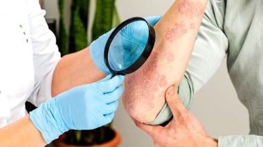 Cada vez más pacientes con psoriasis postergan o suspenden la consulta médica por motivos económicos