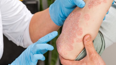 Campañas gratuitas de detección de enfermedades dermatológicas