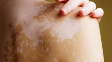 El vitiligo sigue planteando desafíos terapéuticos