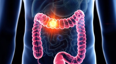 En Argentina hay 22 muertes diarias por cáncer de colon: ¿Cómo evitarlas?