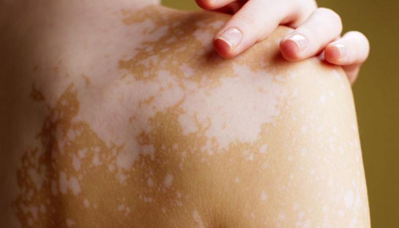 El vitiligo sigue planteando desafíos terapéuticos
