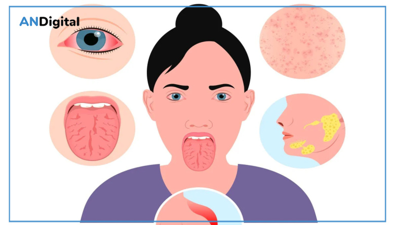Sjögren: una enfermedad autoinmune que va más allá de la sequedad ocular y bucal