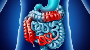 Avances para mejorar la calidad de vida de  pacientes con Enfermedad Inflamatoria Intestinal