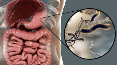Importante logro del Registro Argentino de manejo de la Helicobacter pylori