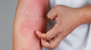 Oportunidad: campaña de detección gratuita de dermatitis atópica
