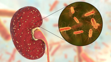 SUH, la principal causa de insuficiencia renal en niños
