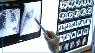 Cáncer de pulmón: es vital avanzar en estrategias de detección temprana