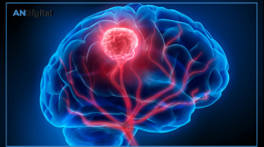 Gliomas de bajo grado IDH mutados en adultos y la necesidad del diagnóstico temprano