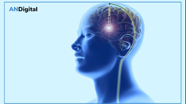 Estimulación cerebral profunda: una cirugía que puede mejorar la calidad de vida en pacientes con Parkinson