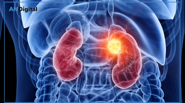 Cáncer de riñón, un tumor que habitualmente no avisa