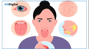 Sjögren: una enfermedad autoinmune que va más allá de la sequedad ocular y bucal