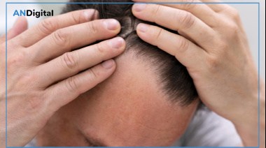 Cada vez más temprano: 1 de cada 3 hombres argentinos convive con la pérdida de cabello