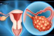 La ciencia cambió el foco: el cáncer de ovario podría originarse en las trompas de Falopio